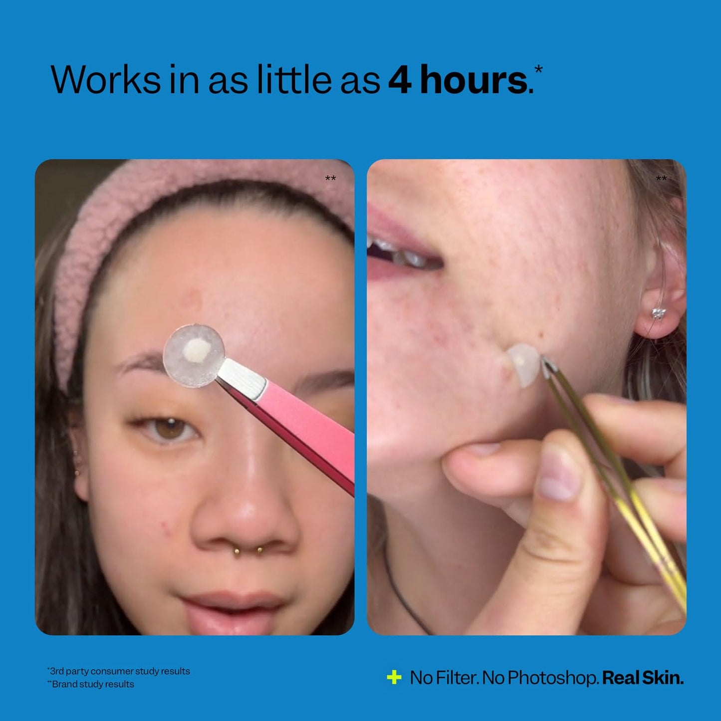 | Acne Spot Dots | Hydrocolloid Acne Patches | for Zits, Blemishes, & Breakouts | Vegan | Cruelty-Free | Pimple Patches | Facial Skin Care Products | 3 Sizes (7Mm, 10Mm, & 12Mm) | 30 Ct